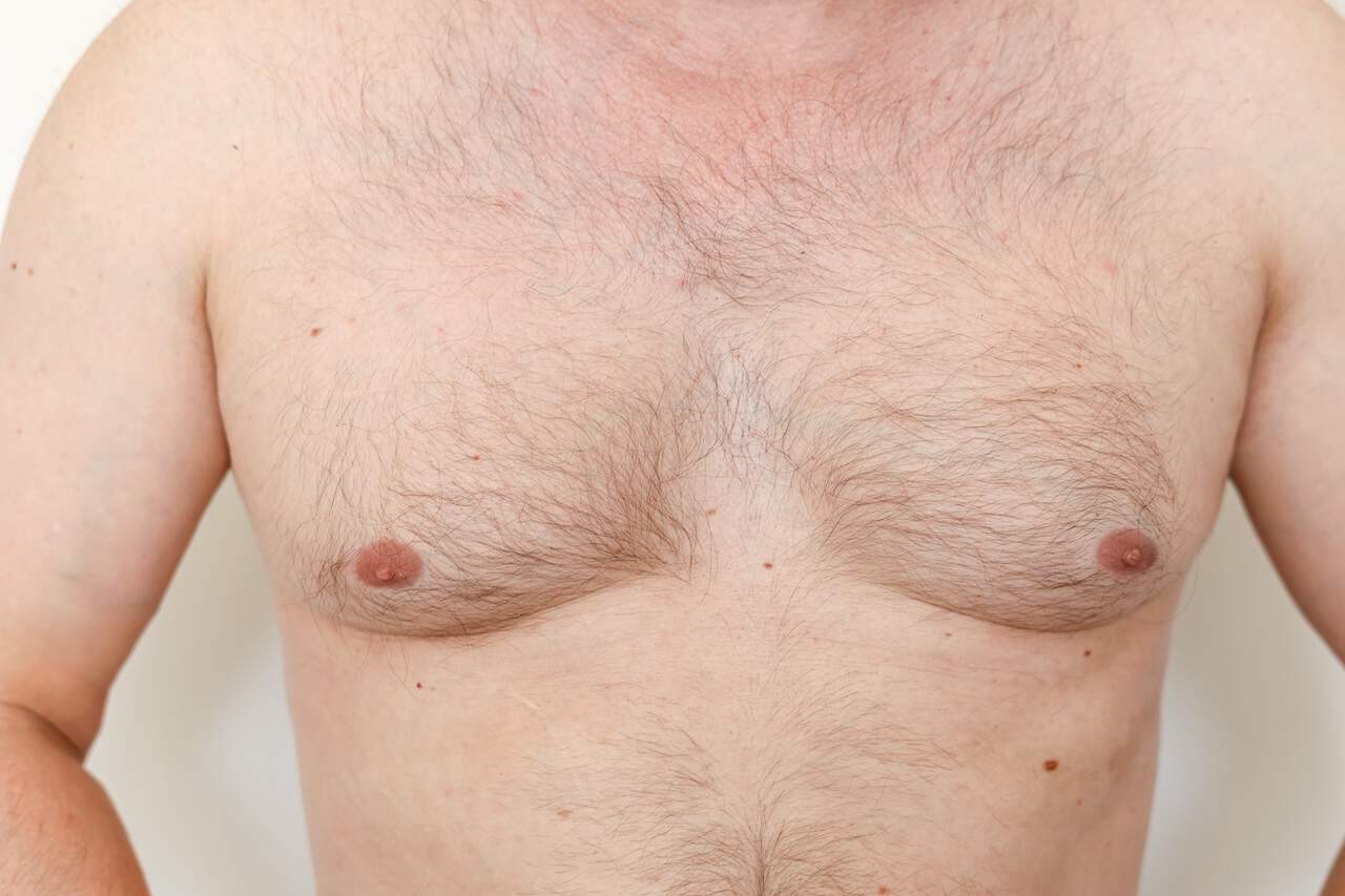Adult Gynecomastia Surgery Miami