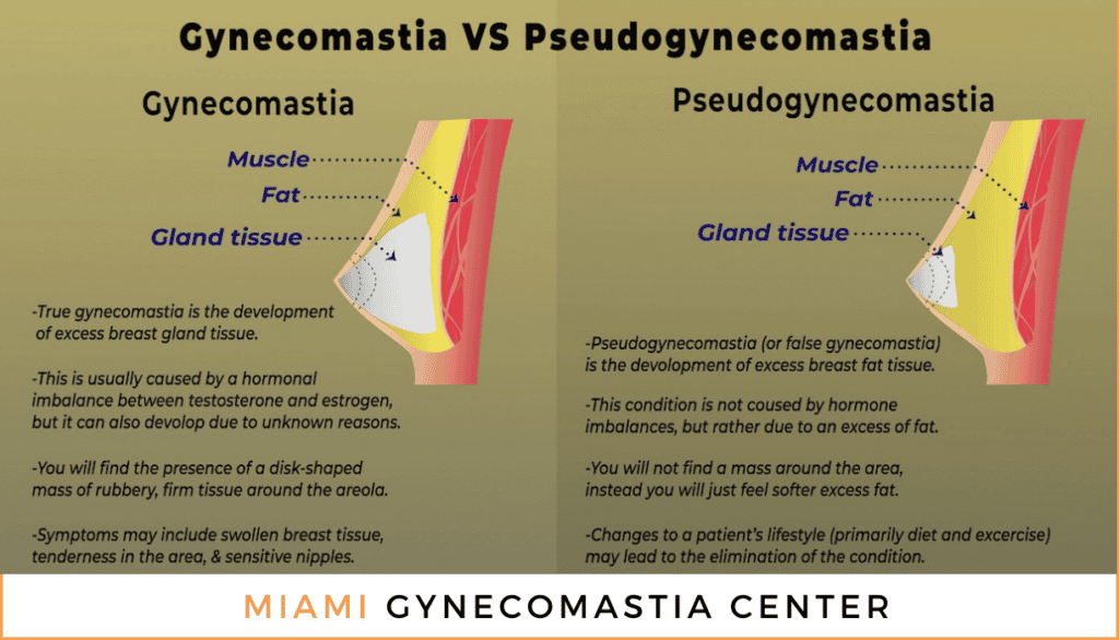 Gynecomastia vs. Pseudogynecomastia