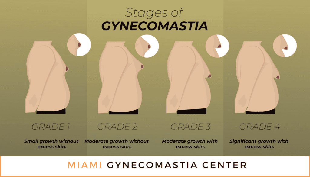 Stages and Grades of Gynecomastia